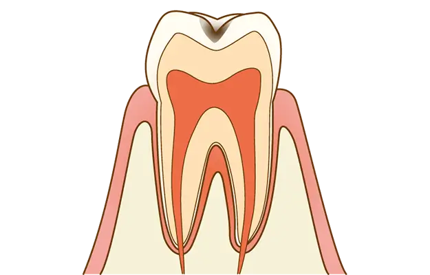 C1(エナメル質の虫歯)